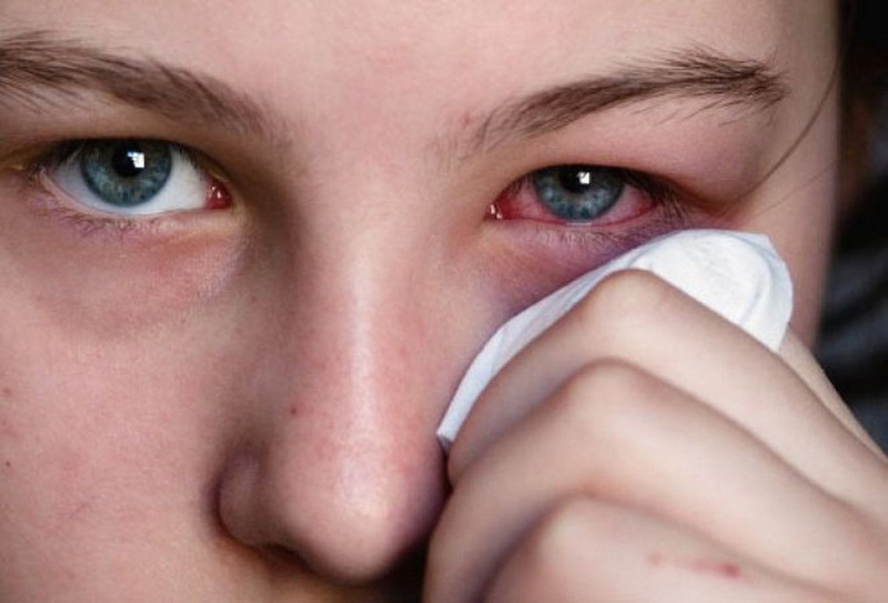 Người bệnh bị khô mắt là do thiếu hụt về số lượng, chất lượng nước mắt dẫn đến không còn tác dụng bôi trơn và dinh dưỡng các cấu trúc bề mặt nhãn cầu. 